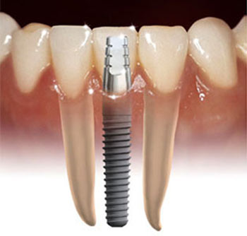 Dental Implant Surgery