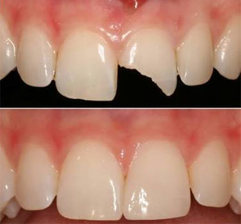 Benefits of Composite / Cosmetic Fillings